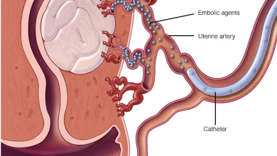 Uterine Fibroid Treatments | USA FIBROID CENTER
