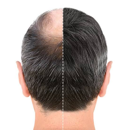 Boosting Confidence With Hair Transplantation In Malaysia