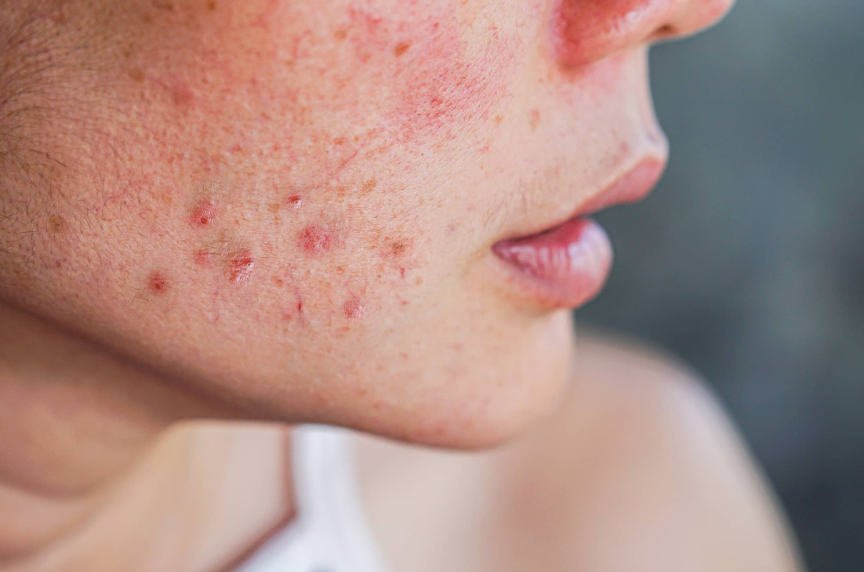 Menopausal Acne – Challenges and Solutions