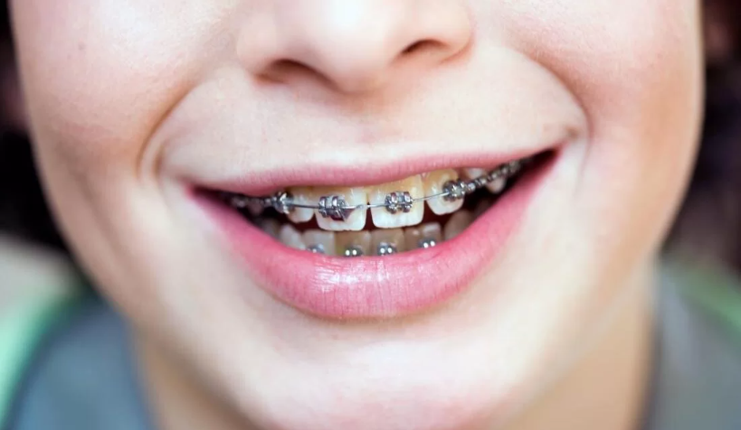 Braces: The When, Why and How?