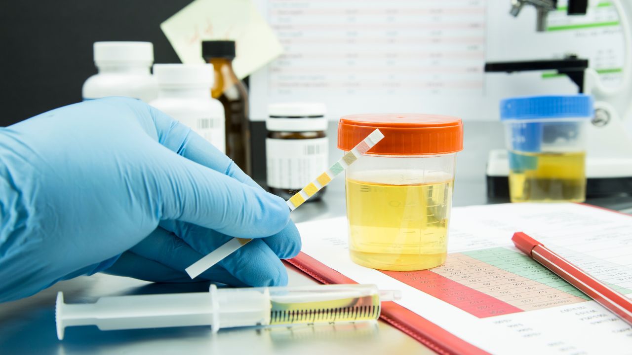 The Shelf Life of Urine for Drug Testing: What You Need to Know