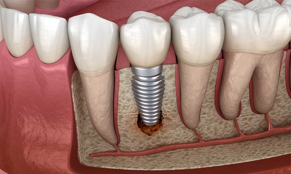 Your Perfect Smile Unlocked: Periodontics & Dental Graft Masters